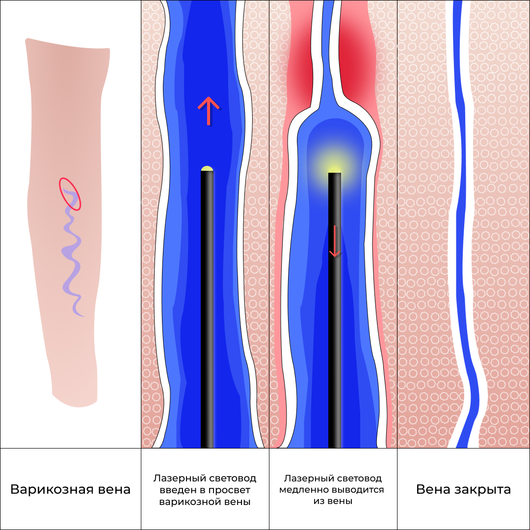 Лазерная облитерация вен нижних. Лазерная облитерация вен. Варикозно расширенная Вена. Клеевая облитерация вен.